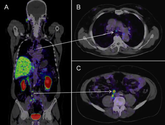Ga-68 PSMA PET-CT