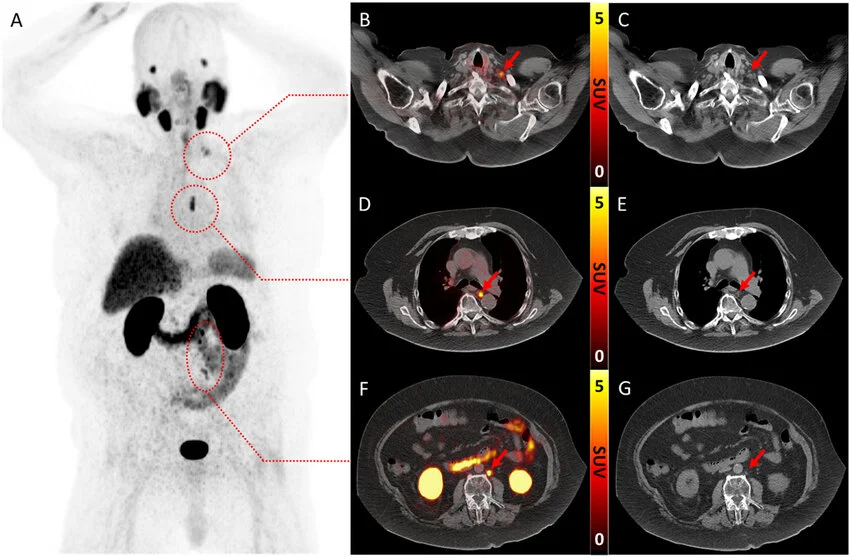 PET-CT Cihazı ve Uygulama