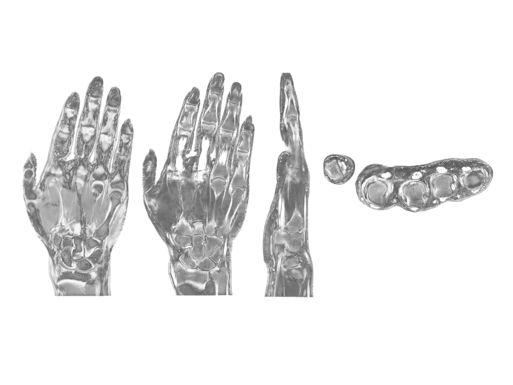 United Wrist MRI İmage